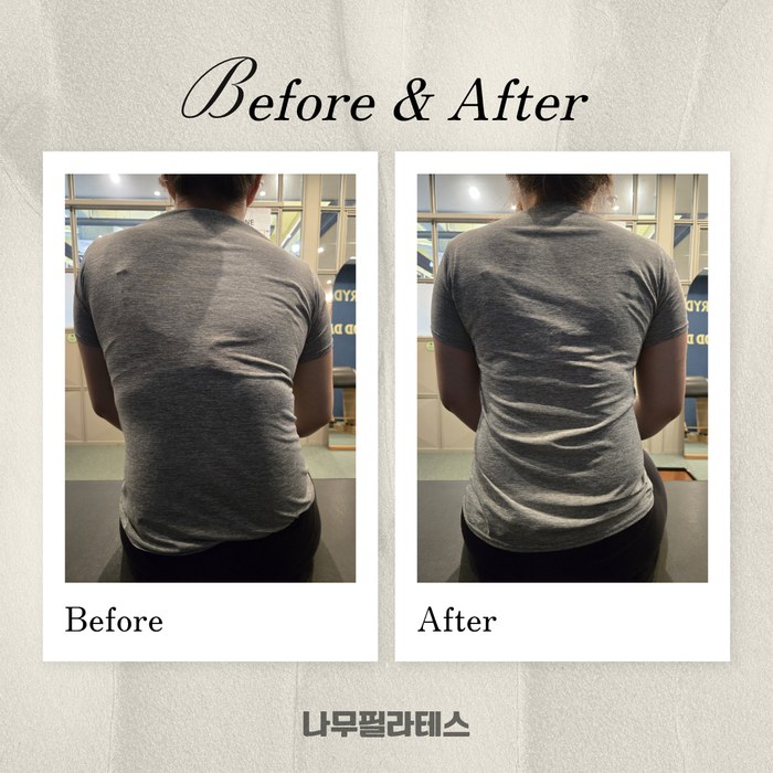 정관점 회원 체형 측만 교정 Before & After 사례