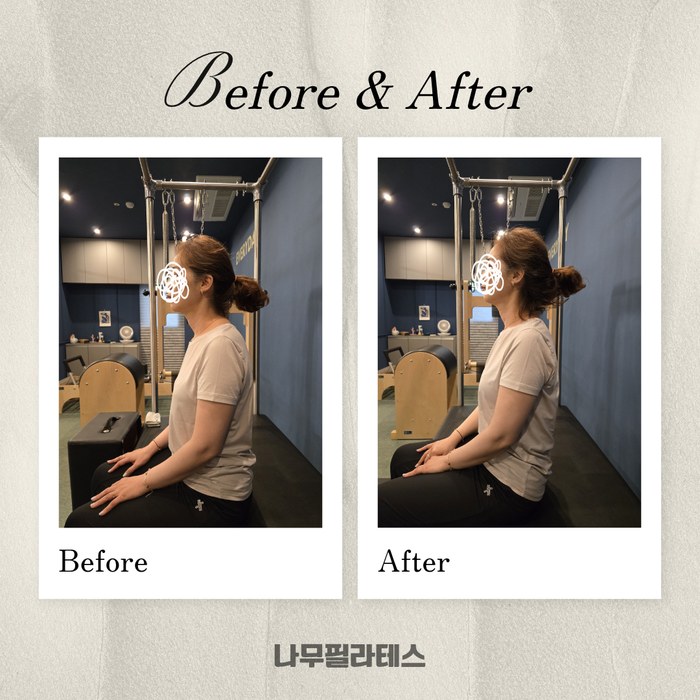정관점 회원 거북목 교정 Before & After 사례
